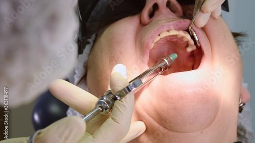 Dentist making local anaesthesia shot before surgery. Senior woman at dental clinic. Dentist with assistant install implant in a patient mouth in modern dental office