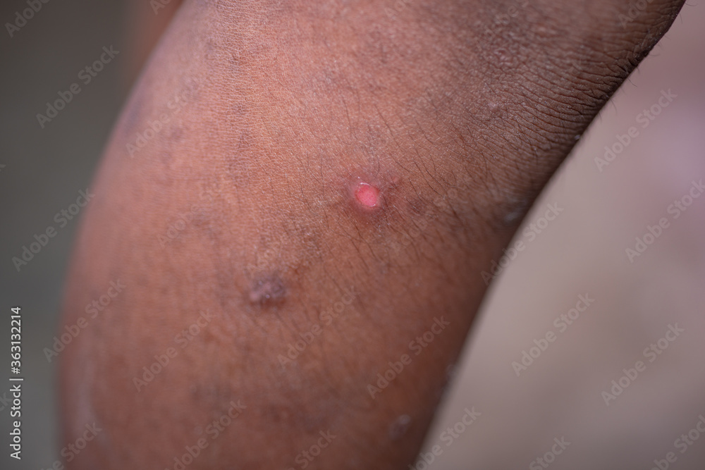 Fototapeta premium Many scars on the legs