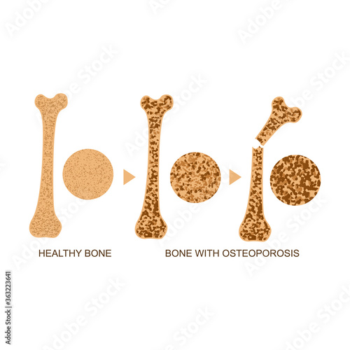 Osteoporosis Bone Infographics Concept Card Poster. Vector