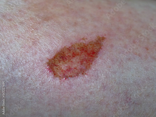 Foto abrasion scar tissue