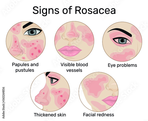 An illustration of the five signs of rosacea such as redness of the skin, papules and pustules, visible blood vessels, thickening of the skin, and eye problems