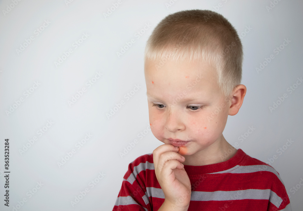 An allergist or dermatologist examines red spots on a child’s face. The boy suffers from a rash, hives and itching. Food Allergy, Insect Bite, Measles or Chicken Pox An allergist or dermatologist examines red spots on a child’s face. The boy suffers from a rash, hives and itching. Food Allergy, Insect Bite, Measles or Chicken Pox