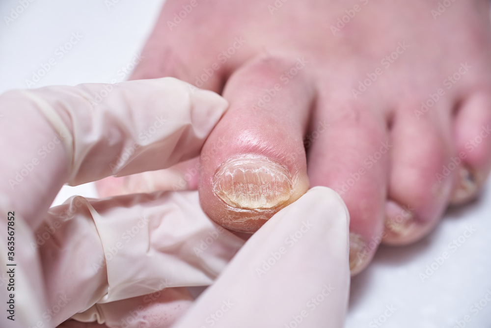 Podiatrist treating feet during procedure, examines the foot. Professional medical pedicure. Podiatry clinic Foot treatment. Podiatrist treating feet during procedure, examines the foot. Professional medical pedicure. Podiatry clinic Foot treatment.