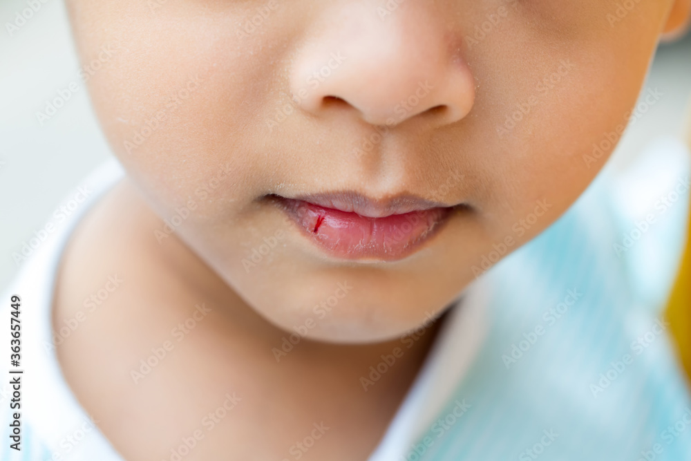Cracked lips of child. The bleeding and swollen lip of a little boy, injured and in hospital, pediatric and childhood healthcare concept. Cracked lips of child. The bleeding and swollen lip of a little boy, injured and in hospital, pediatric and childhood healthcare concept.