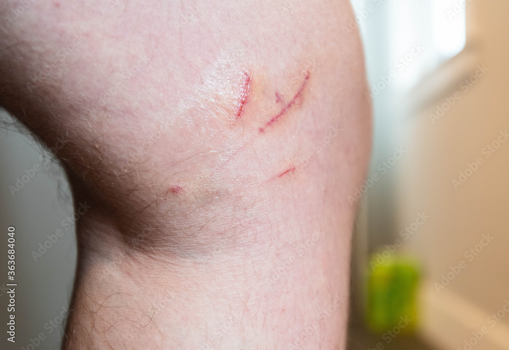 Fototapeta premium Deep cuts and scrapes from pet cat attack on man's knee.