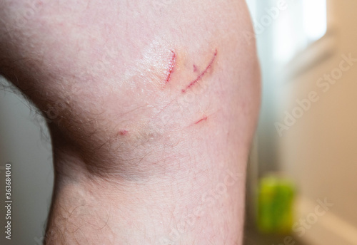 Deep cuts and scrapes from pet cat attack on man s knee.