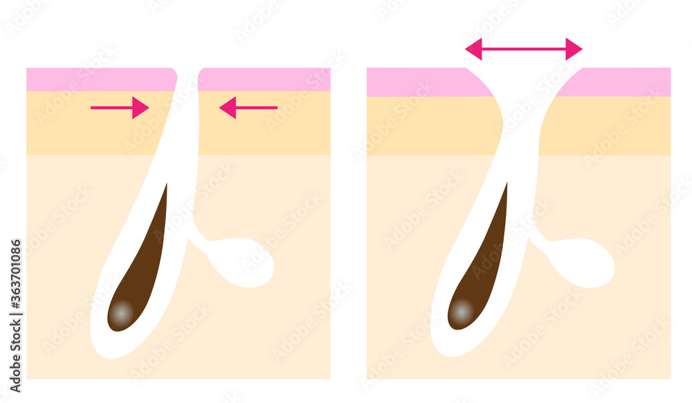 開き毛穴 ビフォアアフター 肌の断面図 Stock Vector Adobe Stock