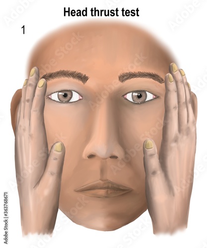 Obraz na plátně Head thrust test is the test of vestibular ner e function.
