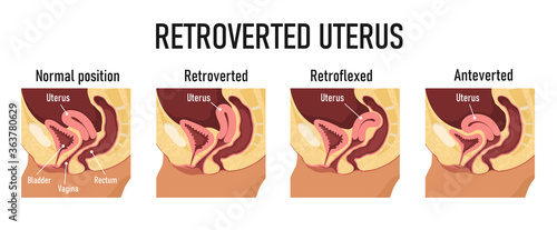 Retroverted uterus. Diagram for variants of uterine position