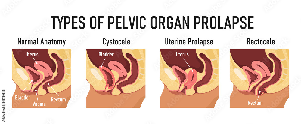 types-of-pelvic-organ-prolapse-cystocele-uterine-prolapse-rectocele