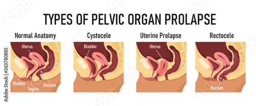 Types of pelvic organ prolapse - cystocele, uterine prolapse, rectocele photo