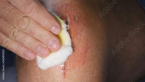 Doctor Cleaning Infected Foot Wound Using Medical Disinfectant and Bandage in Hospital Emergency Room