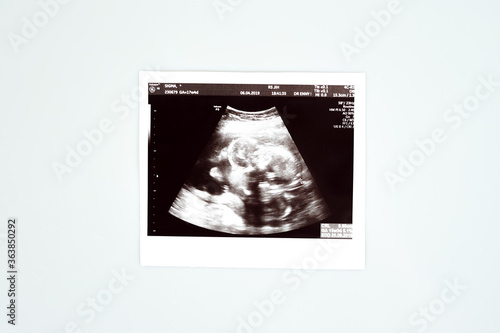 Result of ultrasound picture or ultrasonography for pregnancy on top of white isolated background