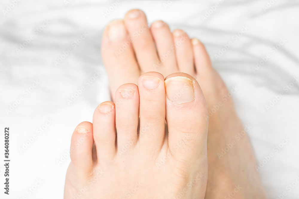 Toenails on a woman's feet Toenails on a woman's feet