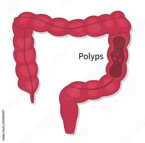 Colonoscopy endoscopic examination of the large bowel. Colorectal cancer screening. Flat vector illustration of polyps fleshy growth removing procedure on white background.