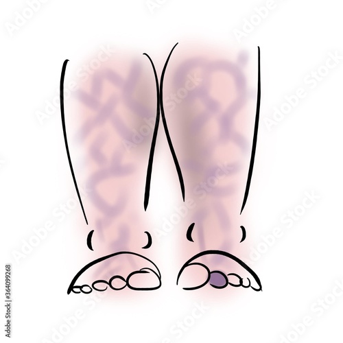 Livedo reticularis and blue finger