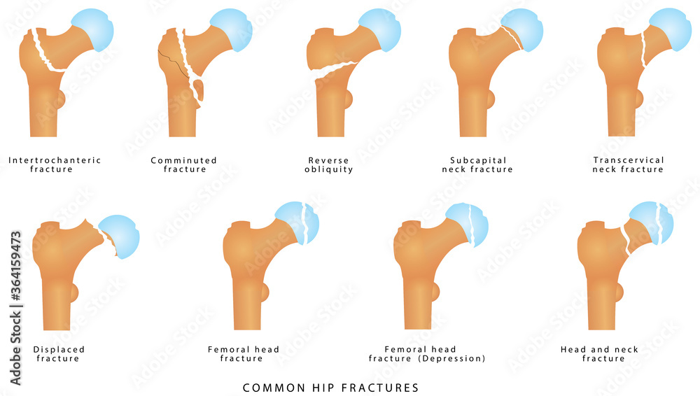 Hip fractures. Fractures of the proximal femur. Types of femoral neck