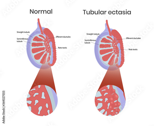 Tubular ectasia of rete testis with normal testicular anatomy