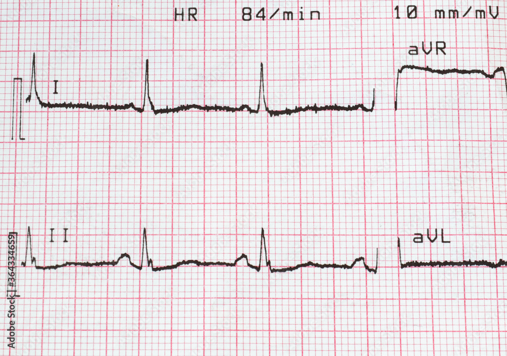 Electrocardiogram test that shows electrical activity of the heart ...