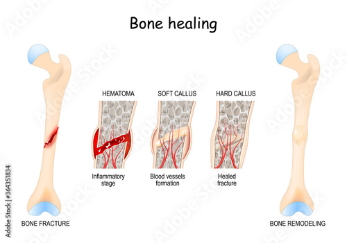 Bone healing Process after a bone fracture.