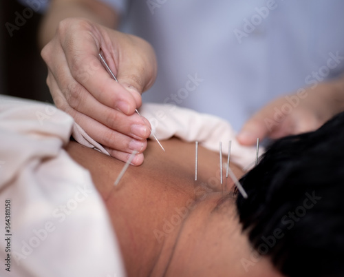 Acupuncture massage