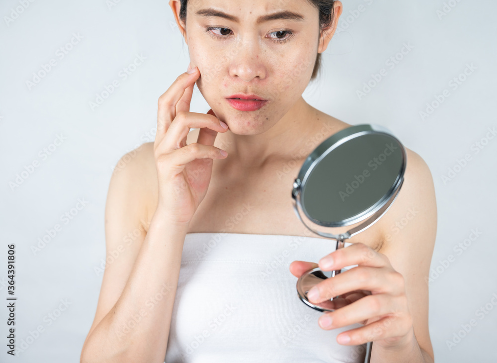 Young Asian woman worry about her face when she saw the problem of acne and scar by the mini mirror. Young Asian woman worry about her face when she saw the problem of acne and scar by the mini mirror.