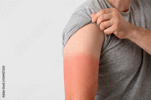 Man with red sunburned skin against light background, closeup