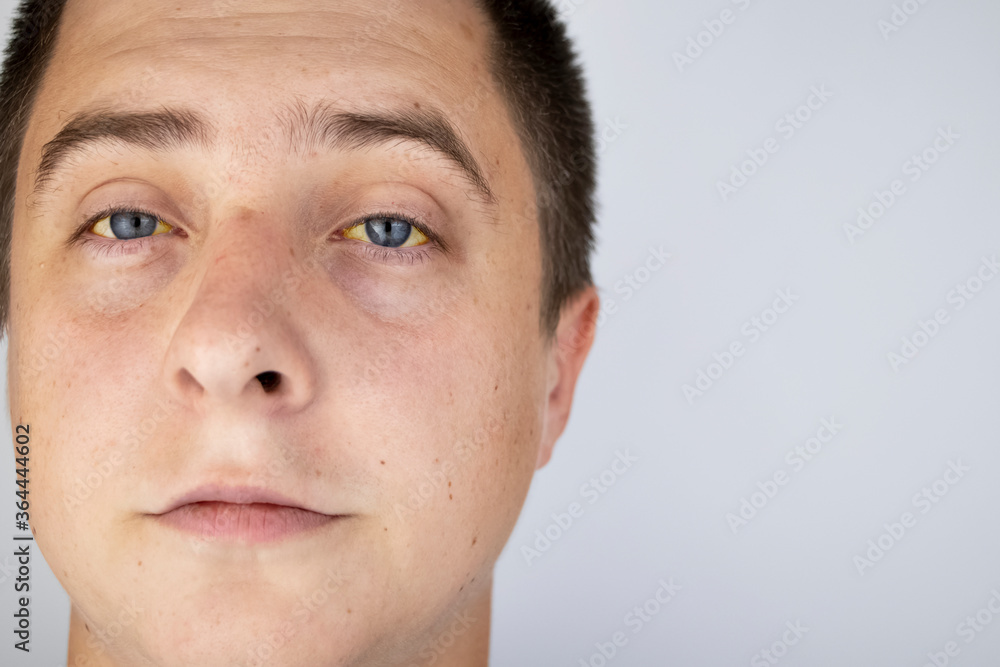 The yellow color of the male eye. Symptom of jaundice, hepatitis or problems with the gall bladder, gastrointestinal tract, liver.