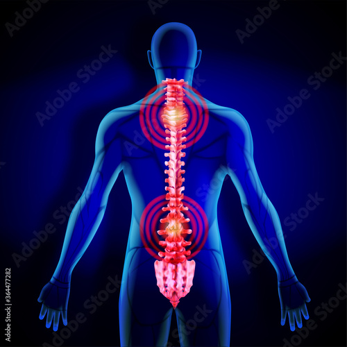 X-ray of the spine. Inflammation in the human spine. Vector illustration.