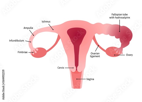 Hydrosalpinx. fallopian tube blocked with a watery fluid due to injury or infection. Uterus with healthy and inflamed tube. Marked with lines. Vector medical illustration.