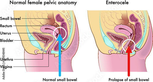 Medical illustration shows the female pelvic anatomy, one with normal small bowel, compared with one with prolapse of small bowel called Enterocele. photo