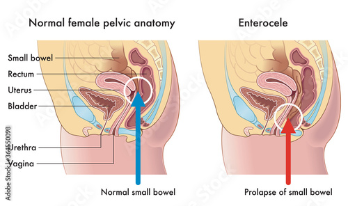 Medical illustration shows the female pelvic anatomy, one with normal small bowel, compared with one with prolapse of small bowel called Enterocele photo