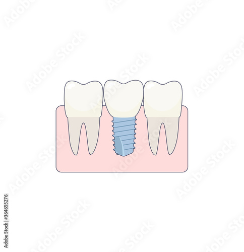 A dental implant placed between two healthy teeth, the abutment is covered with a crown. ivector illustration, in a flat style with a thin line. Inside the oral cavity, the gums, the roots.