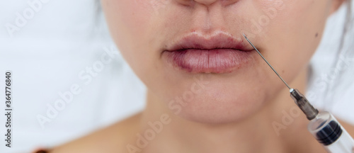 Plastic lips. Women's lips after injections of hyaluronic acid. Complications after lip augmentation, close-up scars and bruises. The concept of cosmetic plastic surgery of the lips.