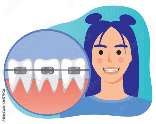 Young girl smiles with braces on teeth as a concept of orthodontic services, flat vector stock illustration with woman and braces for orthodontic clinic