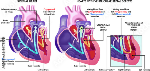 Medical illustration that compares a normal heart with hearts afflicted by ventricular septal defects, an abnormal opening (hole) in the heart, with annotations.