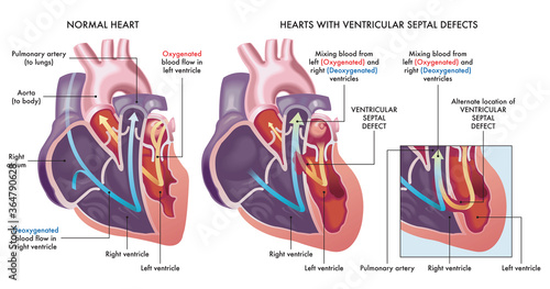 Medical illustration that compares a normal heart with hearts afflicted by ventricular septal defects, an abnormal opening (hole) in the heart, with annotations.