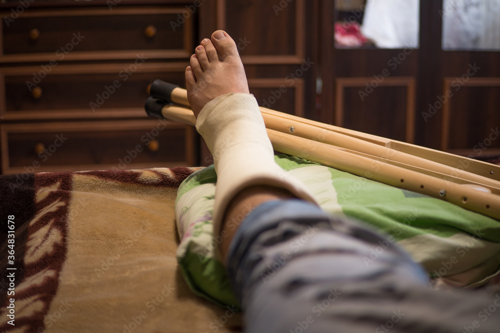 Gypsum is imposed on the man’s leg and walking on crutches is