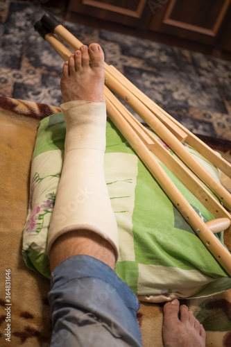 Gypsum is imposed on the man’s leg and walking on crutches is prescribed, and bed rest, as he has a closed fracture of the fibula without displacement.