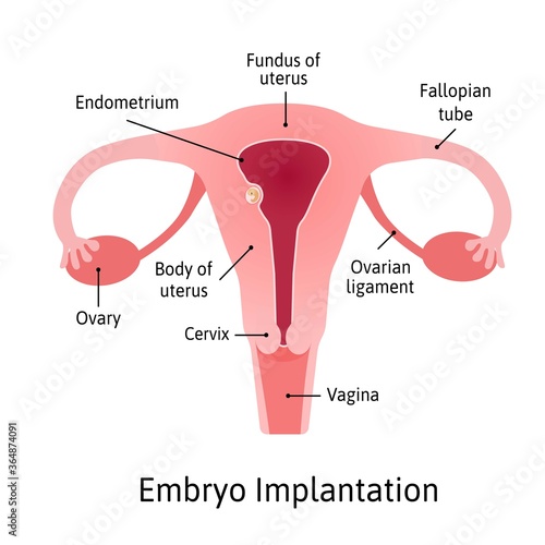 implantation. stage of pregnancy when embryo adheres to the wall of the uterus. Parts of uterus are marked with lines. Vector medical illustration.