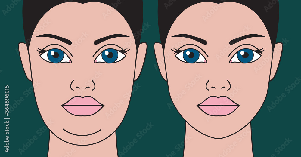 Double chin, restoration of facial contours with aid liposuction Double chin, restoration of facial contours with aid liposuction