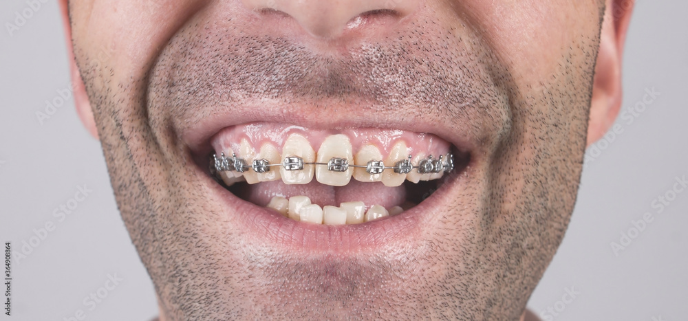 Closeup. Caucasian man with a braces on teeth. Closeup. Caucasian man with a braces on teeth.