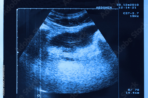 photo of ultrasound of stomach in blue tone