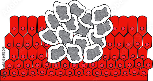 Cancer cell damaging human cells body aids kill human anti-body weaken strengths