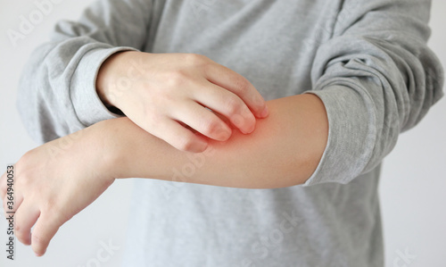 Young asian woman itching and scratching on arm from itchy dry skin eczema dermatitis © Piman Khrutmuang