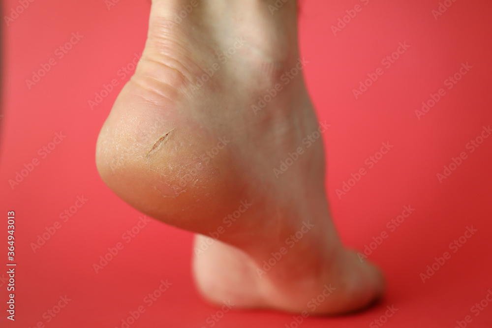 Close-up of badly cracked heel. Persons feet with dry skin. Barefoot adult with unattractive and unhealthy foot. Salon treatment and skin procedure needed concept Close-up of badly cracked heel. Persons feet with dry skin. Barefoot adult with unattractive and unhealthy foot. Salon treatment and skin procedure needed concept