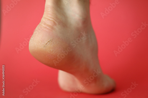 Close-up of badly cracked heel. Persons feet with dry skin. Barefoot adult with unattractive and unhealthy foot. Salon treatment and skin procedure needed concept
