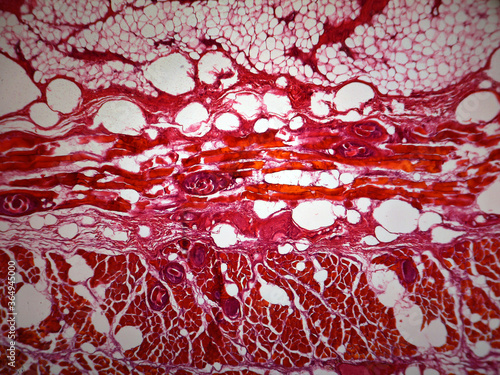 Microphotography of trichinosis parasitizing tissue. Trichinella sp.