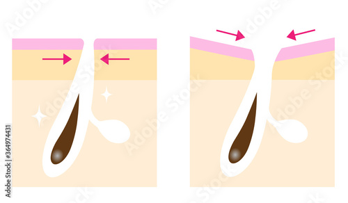 たるみ毛穴　ビフォアアフター　肌の断面図