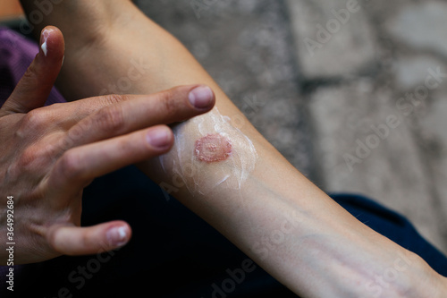 Ring Worm infection, Dermatophytosis on skin. Applying an emollient to dry flaky skin